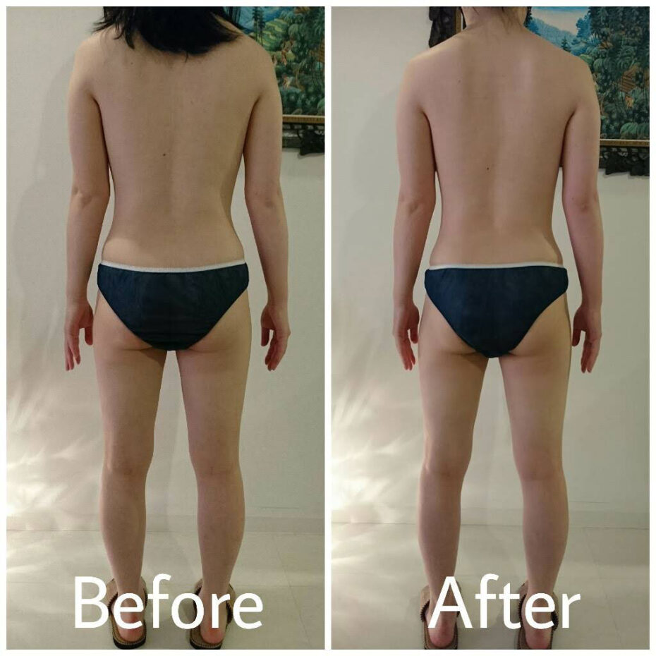 バリニーズ痩身のBefore-After